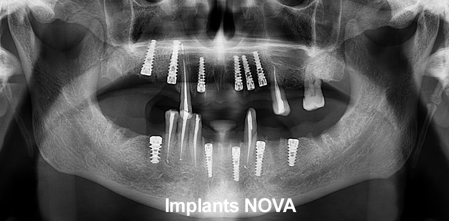 Implant_dentar_protezare_ceramica