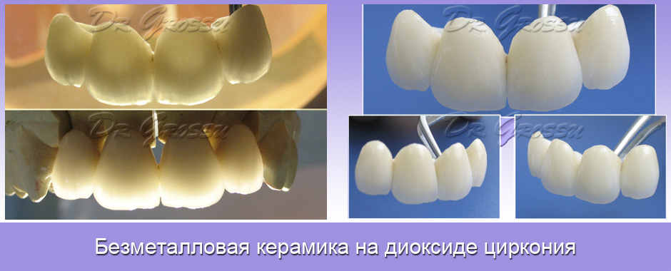 Цирконии_керамика_протезирование_зуб